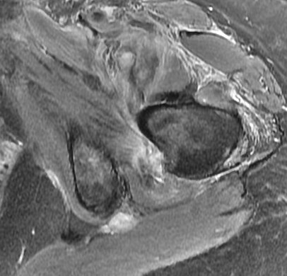 Figure 4 for case Psoas avulsion